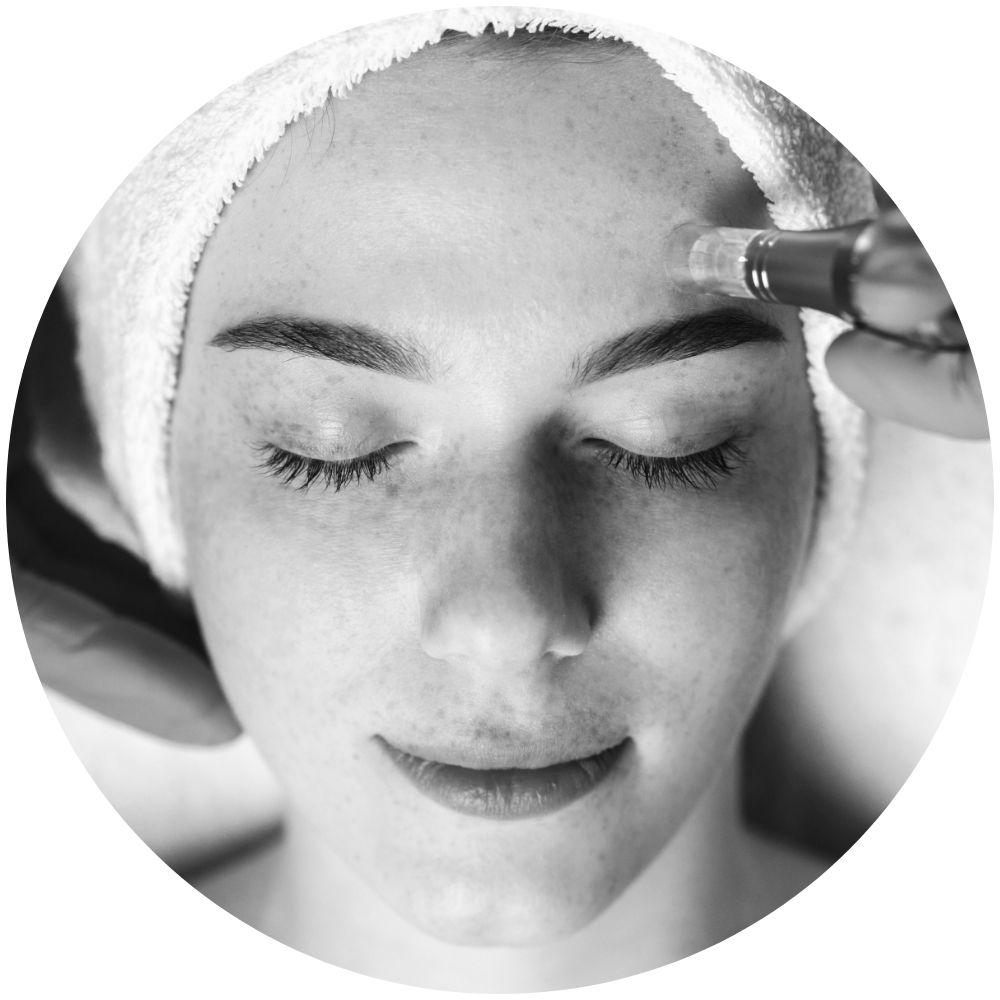 microneedling à bâle bâle