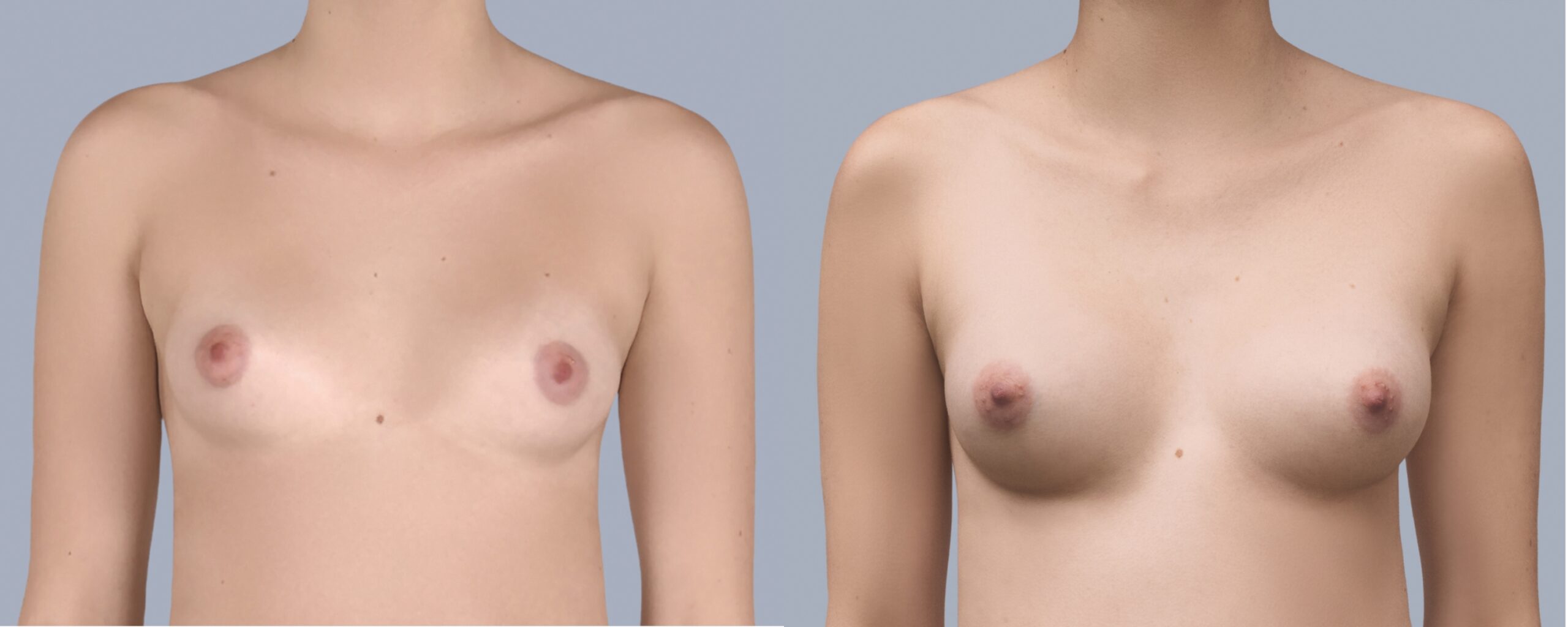 augmentation mammaire mia femtech suisse bâle photos avant après (1)