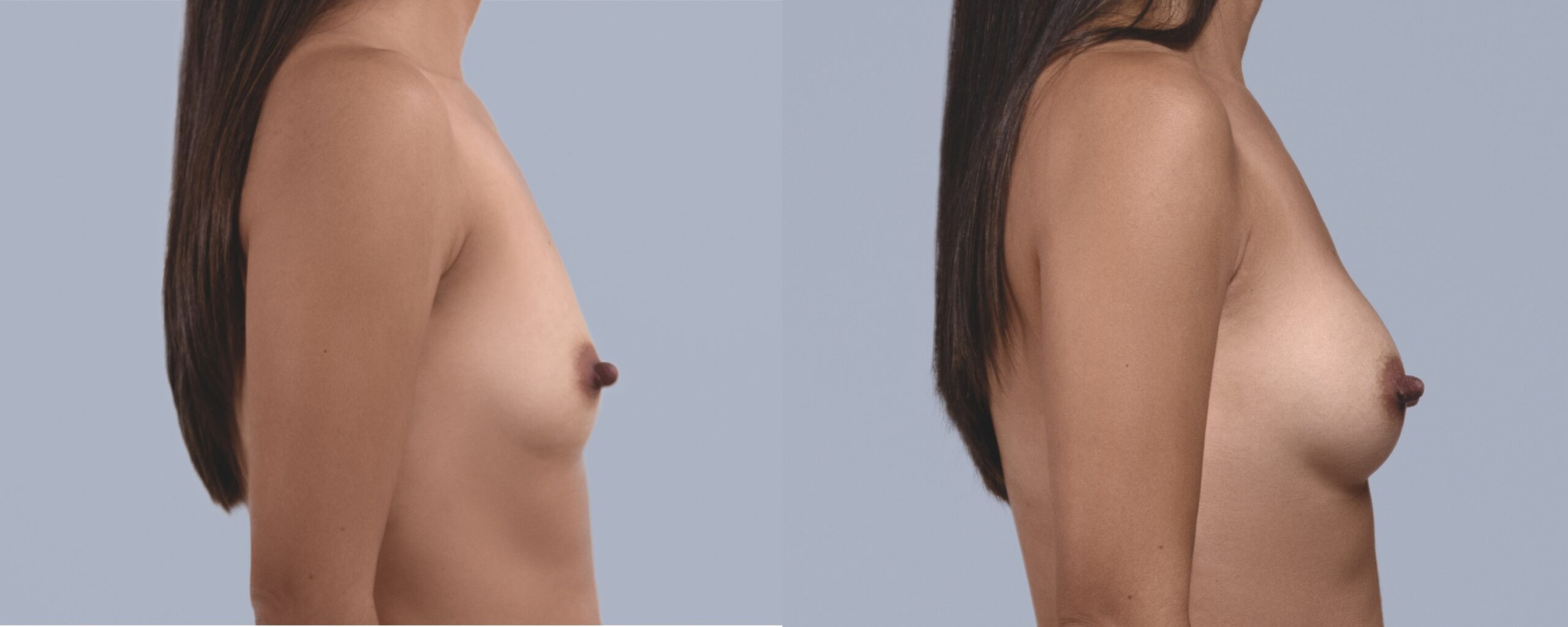 augmentation mammaire mia femtech suisse bâle avant après photos (10)
