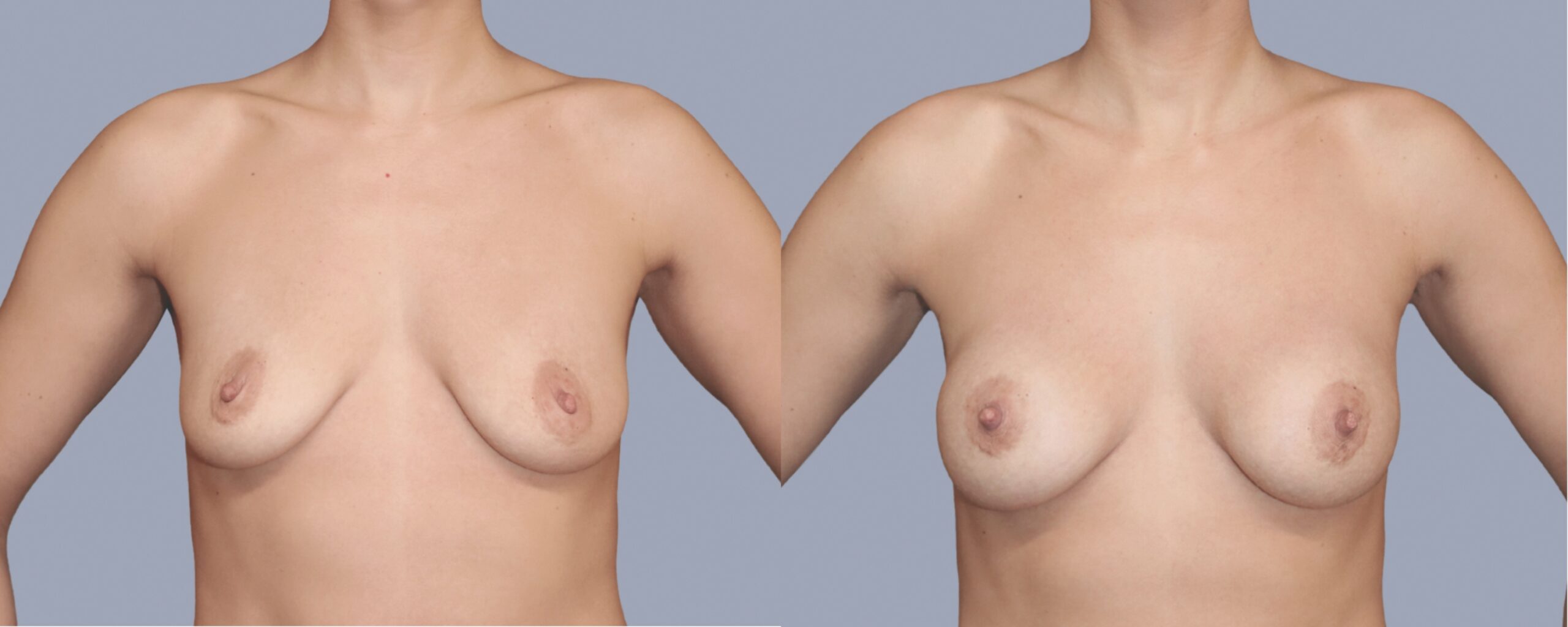 augmentation mammaire mia femtech suisse bâle avant après photos (11)