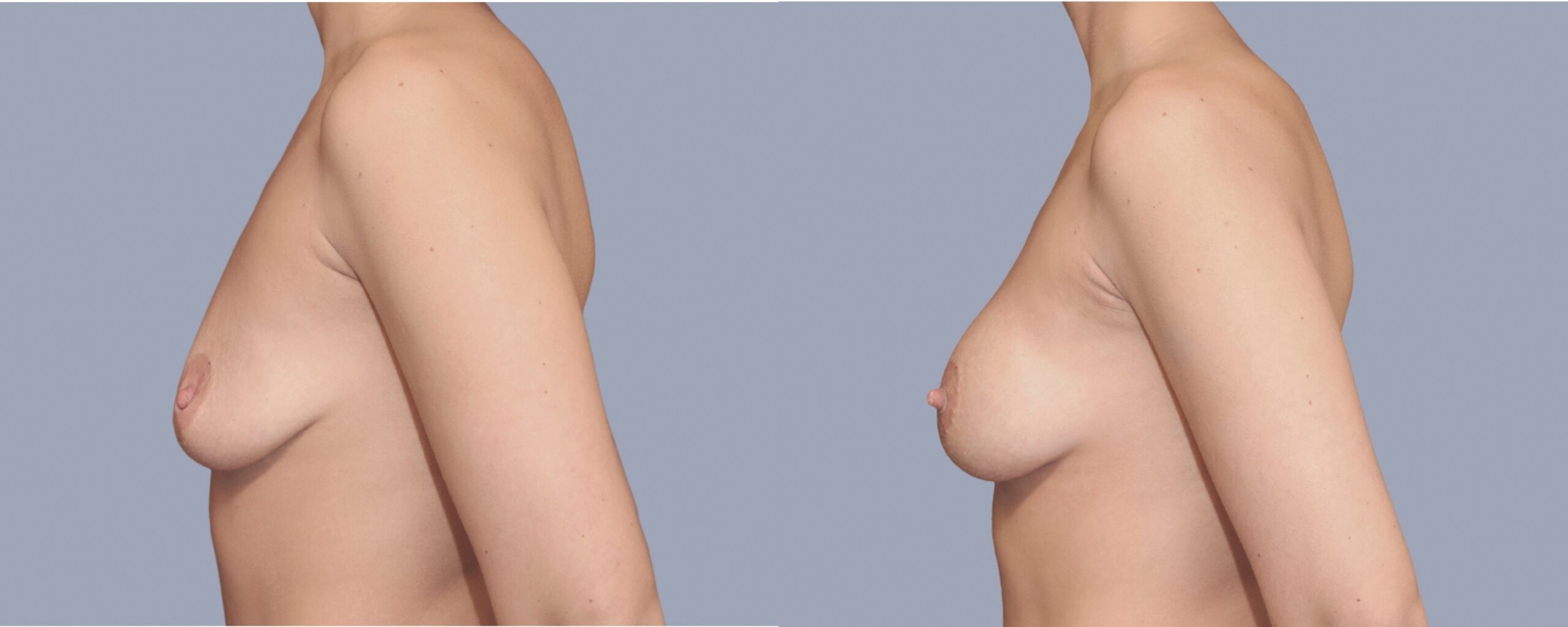augmentation mammaire mia femtech suisse bâle avant après photos (13)