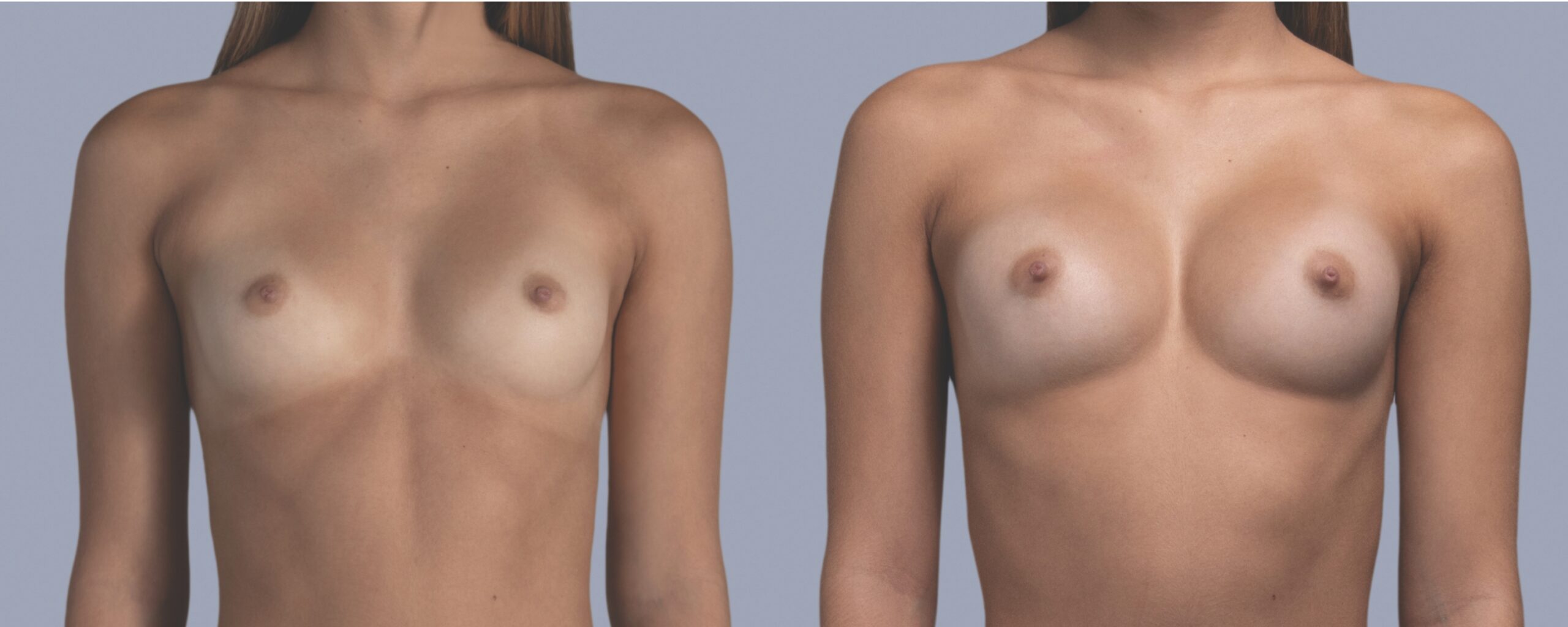 augmentation mammaire mia femtech suisse bâle avant après photos (3)