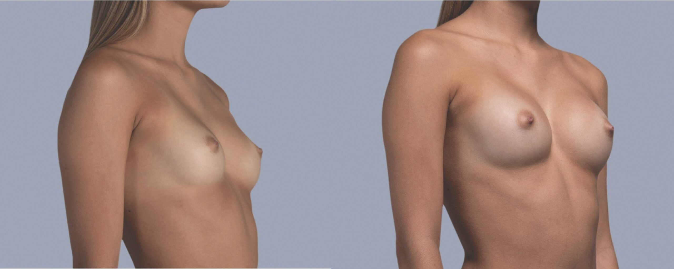 augmentation mammaire mia femtech suisse bâle avant après photos (4)