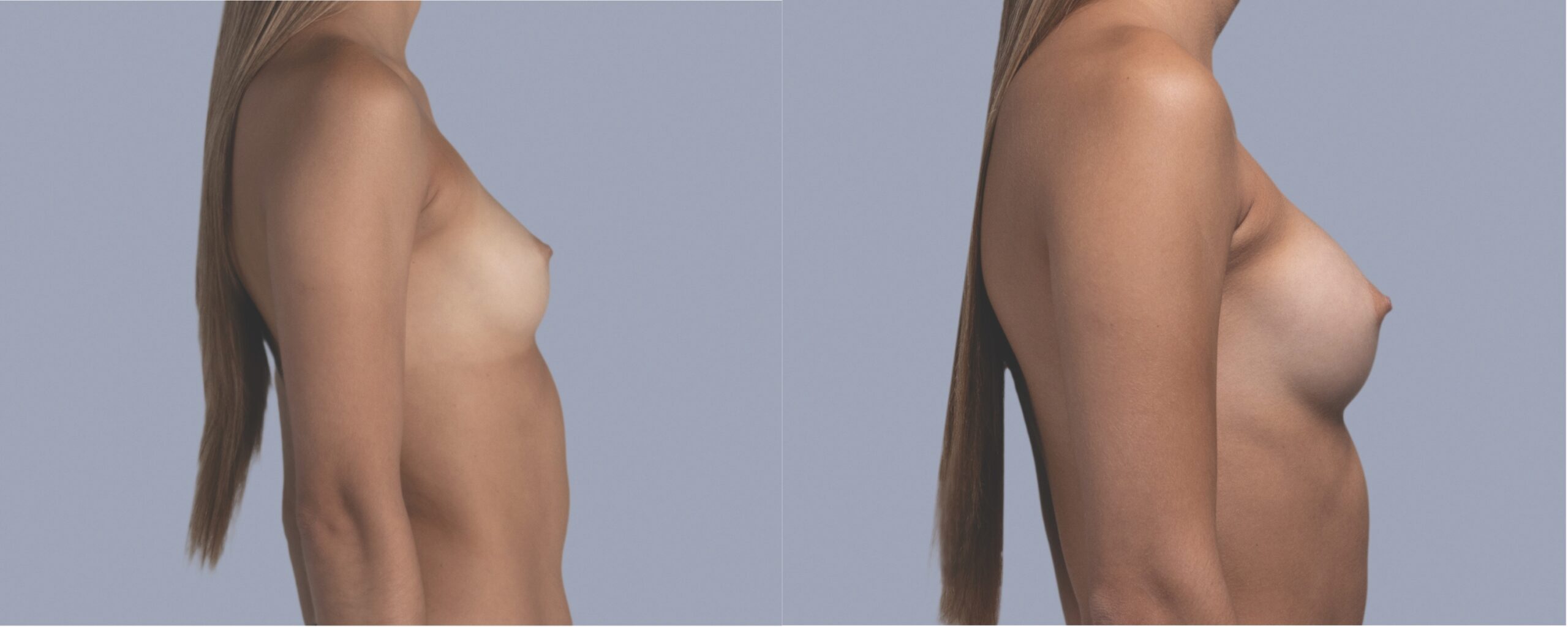 augmentation mammaire mia femtech suisse bâle avant après photos (5)