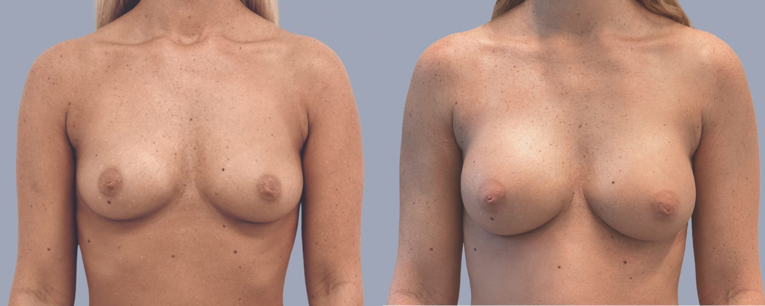 augmentation mammaire mia femtech suisse bâle avant après photos (6)