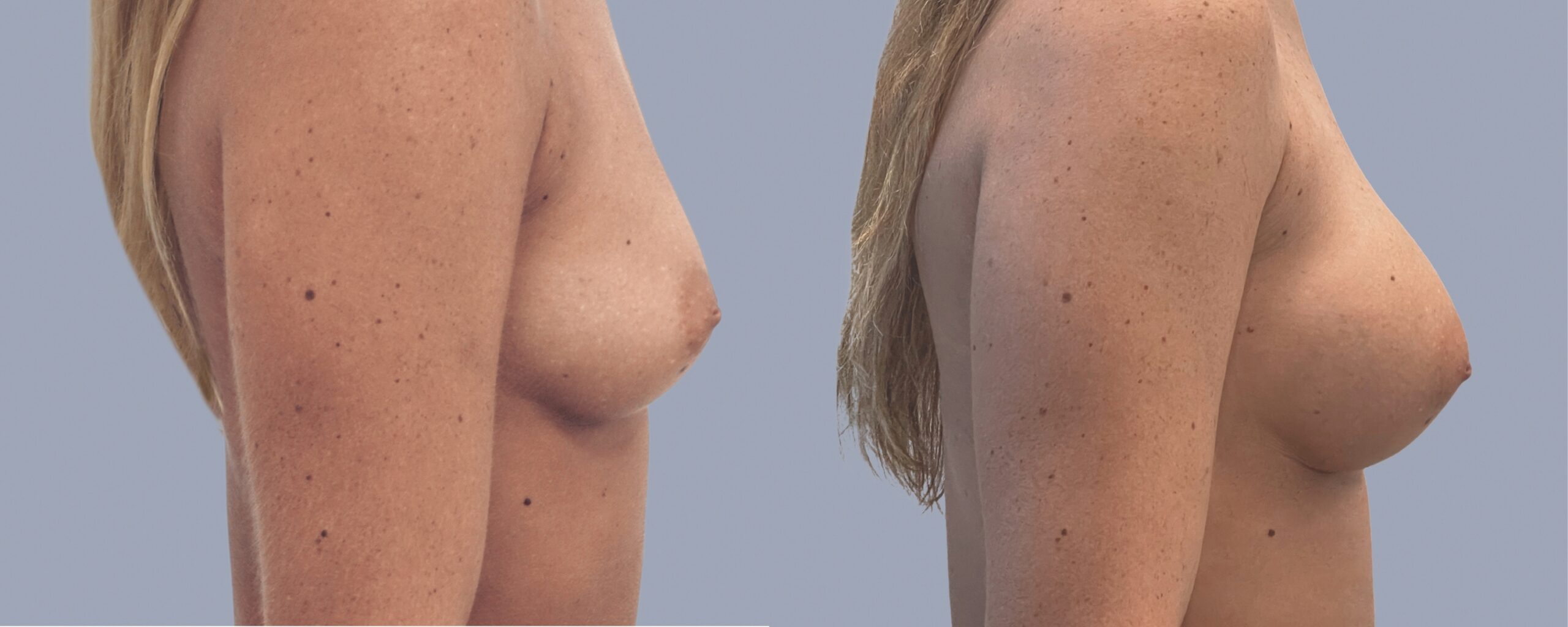 augmentation mammaire mia femtech suisse bâle avant après photos (7)