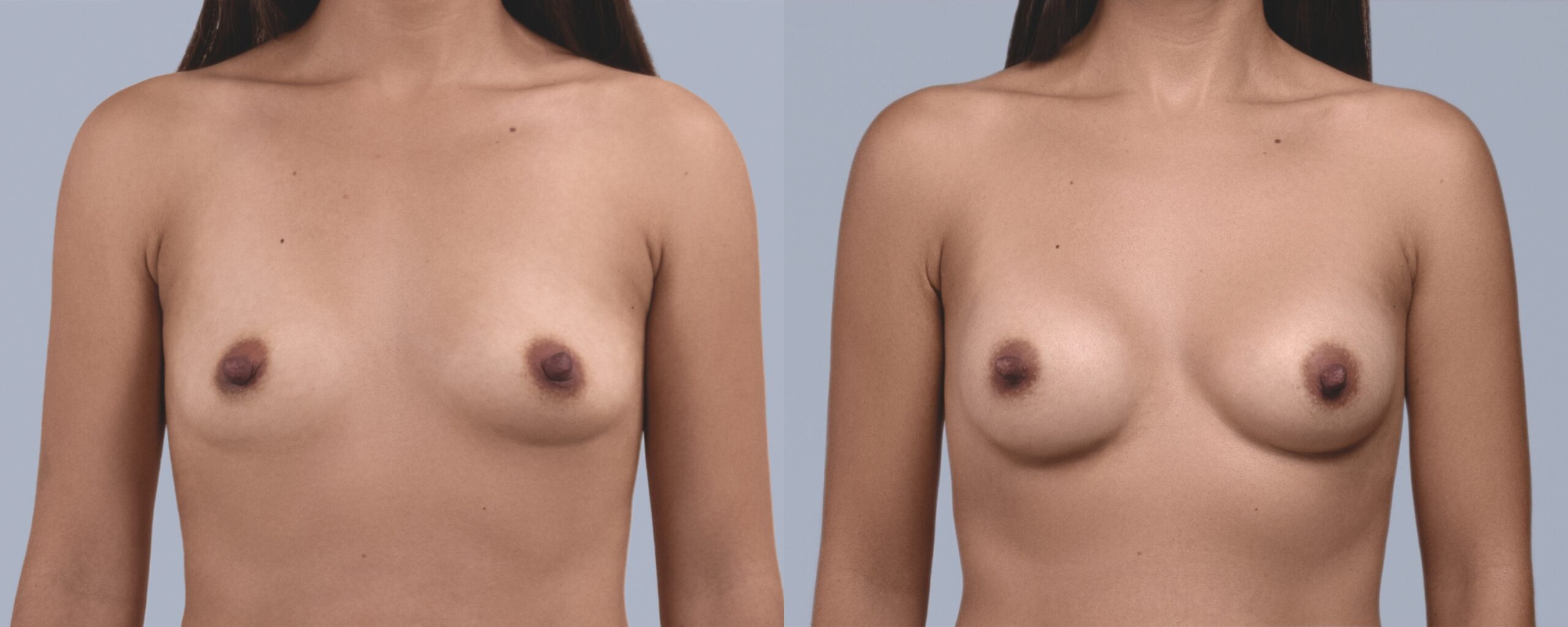 augmentation mammaire mia femtech suisse bâle avant après photos (8)