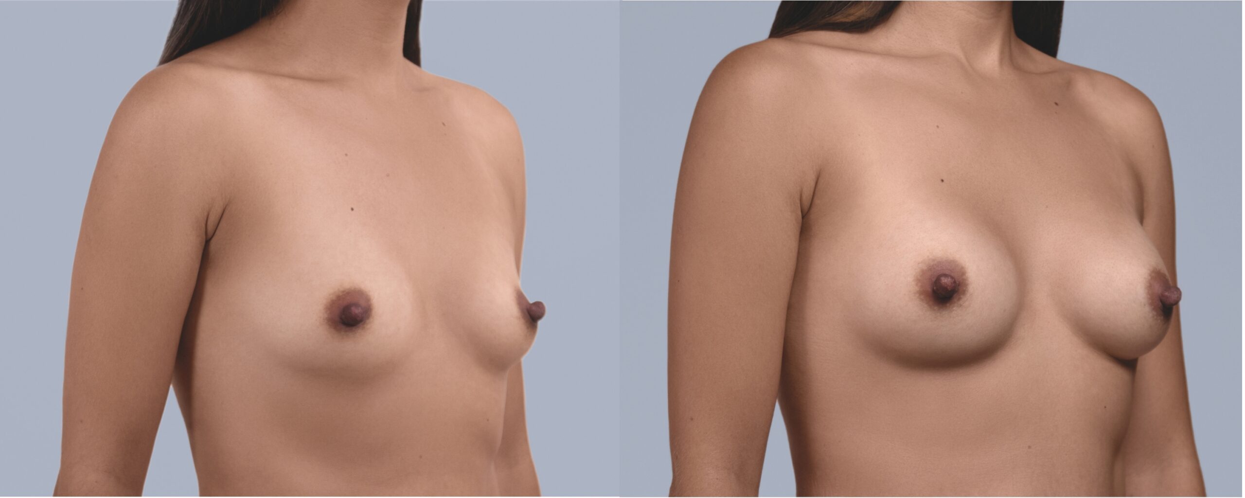 augmentation mammaire mia femtech suisse bâle avant après photos (9)